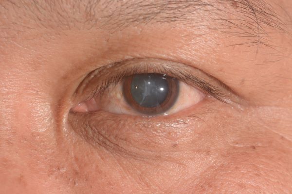 白內障是眼睛中的天然水晶體失去原有透明度的一種病症
