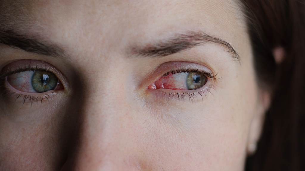 10 Typical Signs Of Dry Eye Disease