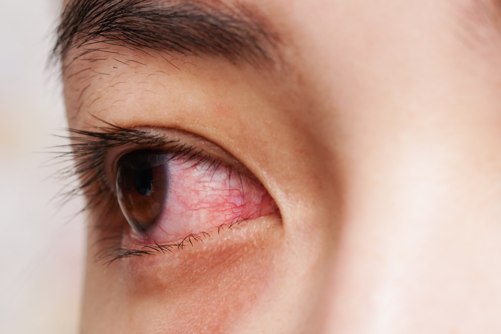 乾眼症的十種常見跡象
