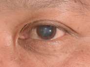 Cataract Surgery And Dry Eye Disease (DED)