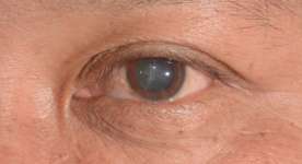 Operasi katarak dapat menyebabkan penyakit mata kering